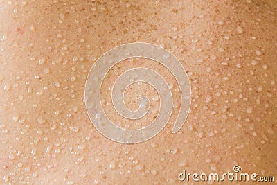 Excessive sweating on human back with freckles. Beads of sweat are forming on the back. Stock Photo