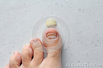 Exfoliation of nail on big toe, close-up in woman, girl. Toenail damage, fungus, trauma, big toe nail problems, nail detachment, Stock Photo