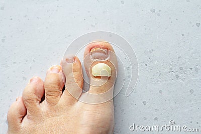 Exfoliation of nail on big toe, close-up in woman, girl. Toenail damage, fungus, trauma, big toe nail problems, nail detachment, Stock Photo