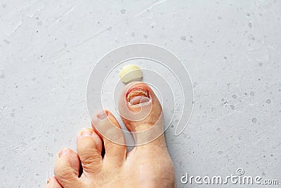 Exfoliation of nail on big toe, close-up in woman, girl. Toenail damage, fungus, trauma, big toe nail problems, nail detachment, Stock Photo