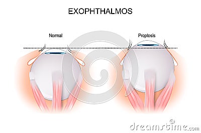 Exophthalmos. comparison and difference Vector Illustration