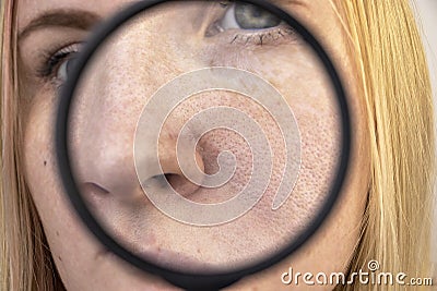 Expanded pores, black spots, acne, rosacea close-up on the nose. A woman is being examined by a doctor. Dermatologist examines the Stock Photo