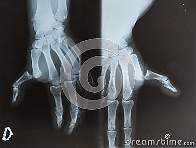 X-ray photo of a human hand with broken thumb Stock Photo