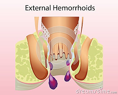 External hemorrhoid. Unhealthy lower rectum with inflamed vascular structures Cartoon Illustration