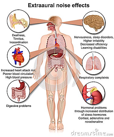 Extraaural health effects of chronic noise exposure medical illustration Cartoon Illustration