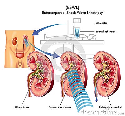 Extracorporeal shock wave lithotripsy Vector Illustration