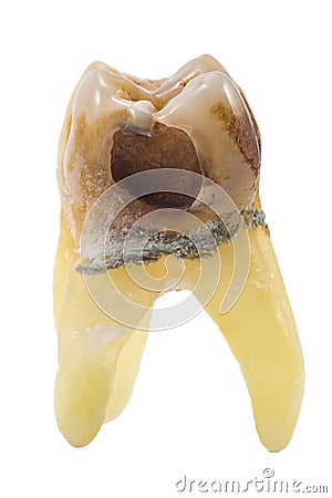 Extracted caries tooth Stock Photo