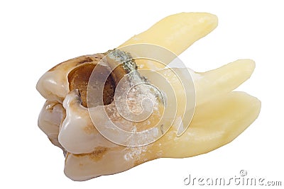 Caries tooth isolated Stock Photo