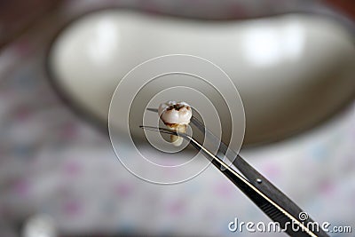 Extracted molar tooth in tweezers Stock Photo