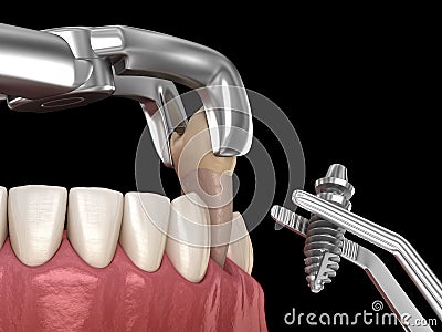 Extraction and Implantation, complex immediate surgery. Medically accurate 3D illustration of dental treatment Cartoon Illustration
