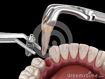 Extraction and Implantation, complex immediate surgery. Medically accurate 3D illustration of dental treatment Cartoon Illustration