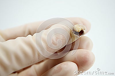 Extractive caries tooth in the hand of a dentist surgeon on a white background Stock Photo