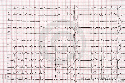 Extrasystole On 12 Lead Electrocardiogram Paper Stock Photo