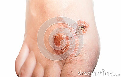 Extreme bad foot skin bacterial fungal infection with damage close up partially isolated on white background close up Stock Photo