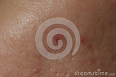 Texture of problematic human skin with large-looking open pores and acne scars Stock Photo