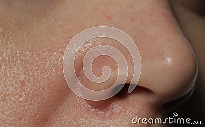 Texture of problematic human skin with large-looking open pores, acne scars and nasolabial fold Stock Photo