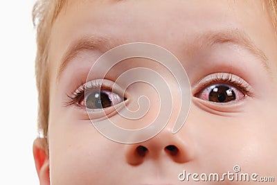 Eye child allergy and conjunctivitis red allergic, pinkeye Stock Photo