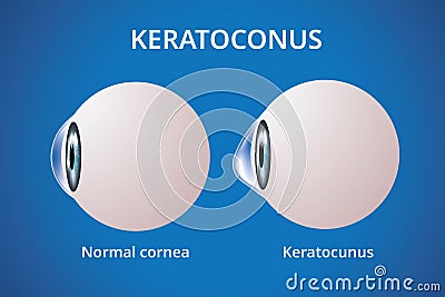 Eye cornea and keratoconus, eye disorder, medical vector Vector Illustration