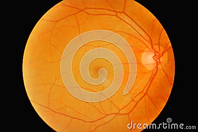 Eye diabetes. Stock Photo