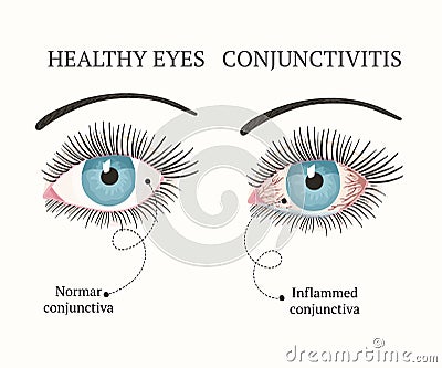 Eye disease. Ophthalmology health illustration. Vector Illustration