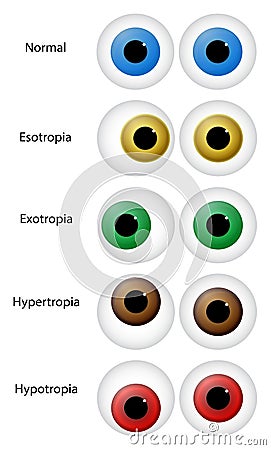 Eye Disorders Vector Illustration