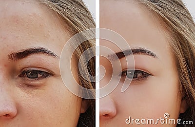 Eye girl bag under the eyes removal before and after treatment cosmetic procedures Stock Photo