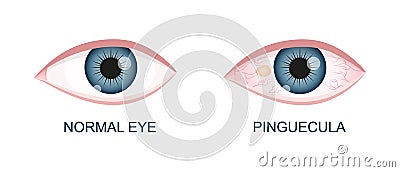 Eye healthy and with pinguecula. Conjunctival degeneration before and after surgery. Eye disease. Human organ of vision Vector Illustration