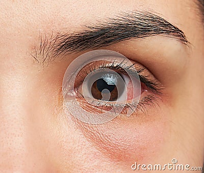 Eye with infection Stock Photo