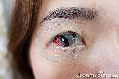Eye injury or infected for healthy concept, macro closeup Stock Photo