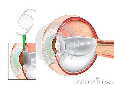 Eye Lens Replacement Surgery. Lens Implant. Cataract Surgery. Intraocular Lenses IOL. Vector Illustration