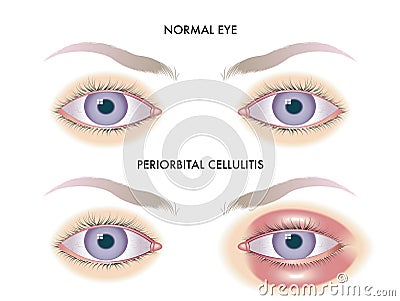 Eye with periorbital cellulitis Vector Illustration