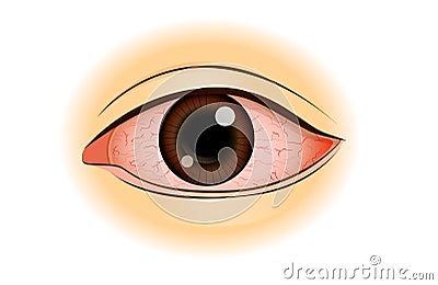 Eye redness symptom of Asian people. Vector Illustration