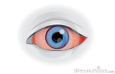 Eye redness symptom of human on white. Vector Illustration