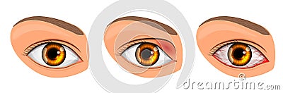 Eye suffering from conjunctivitis and styes Vector Illustration