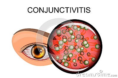 Eye suffering from conjunctivitis and styes Vector Illustration