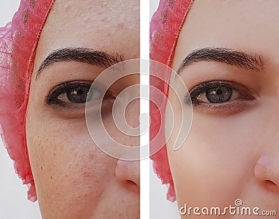 Eye swelling, wrinkles before and after cosmetic pigmentation procedure Stock Photo