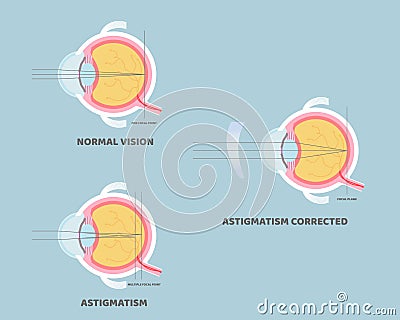 Eyeball anatomy, internal organs body part nervous system, astigmatism corrected, eyesight concept Vector Illustration