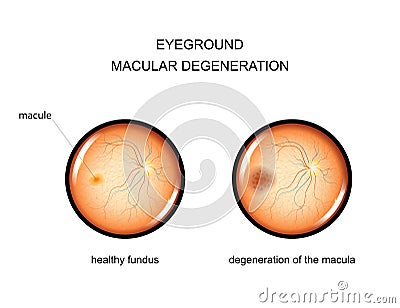 Eyeground. degeneration of the macula Vector Illustration