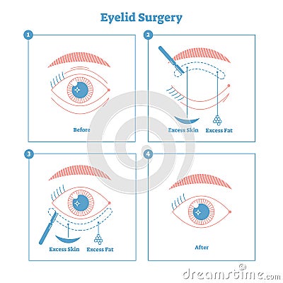 Eyelid surgery procedure scheme illustration. Excess skin and fat removal plastic surgery. Women fashion simple line style design. Vector Illustration