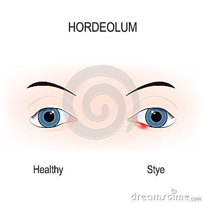 Eyes of human. stye. external hordeolum of lower eyelid. Vector Illustration