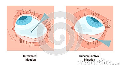 Eyes injection types. Intravitreal and subconjunctival injection. Administration Vector Illustration