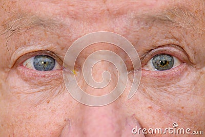 Eyes of a senior man showing unequal pupil dilation Stock Photo