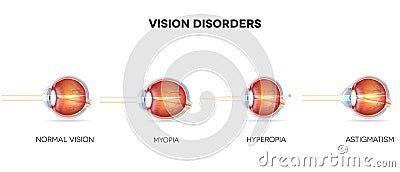 Eyesight disorders Vector Illustration