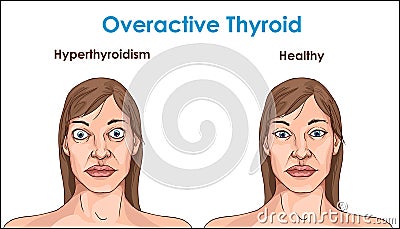 Face of an adult female exhibiting the symptoms of hyperthyroidism. Vector Illustration