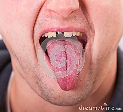 Face with broken tooth and tongue Stock Photo