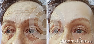 Face elderly woman forehead wrinkles before and after cosmetic procedures Stock Photo