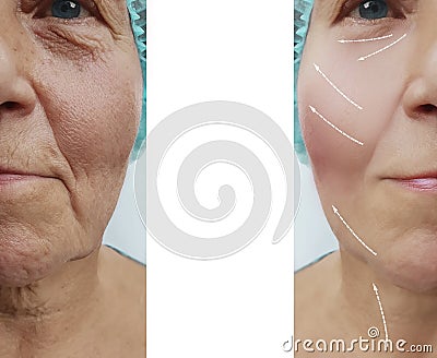 Face of an elderly woman patient wrinkles treatm collagen contrast removal on the face before and after procedures, swollen Stock Photo