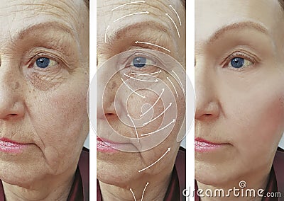 Face, elderly woman, wrinkles, health plastic filler patient contrast correction before and after procedures, arrow Stock Photo