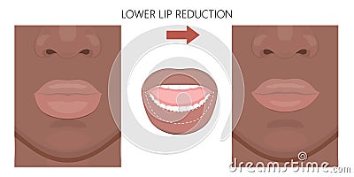 Face front_African American Lower Lip reduction Vector Illustration