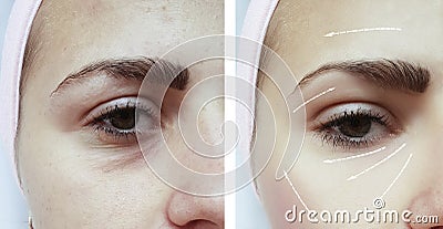 Face girl eyes wrinkles swollen regeneration before and after difference procedures Stock Photo